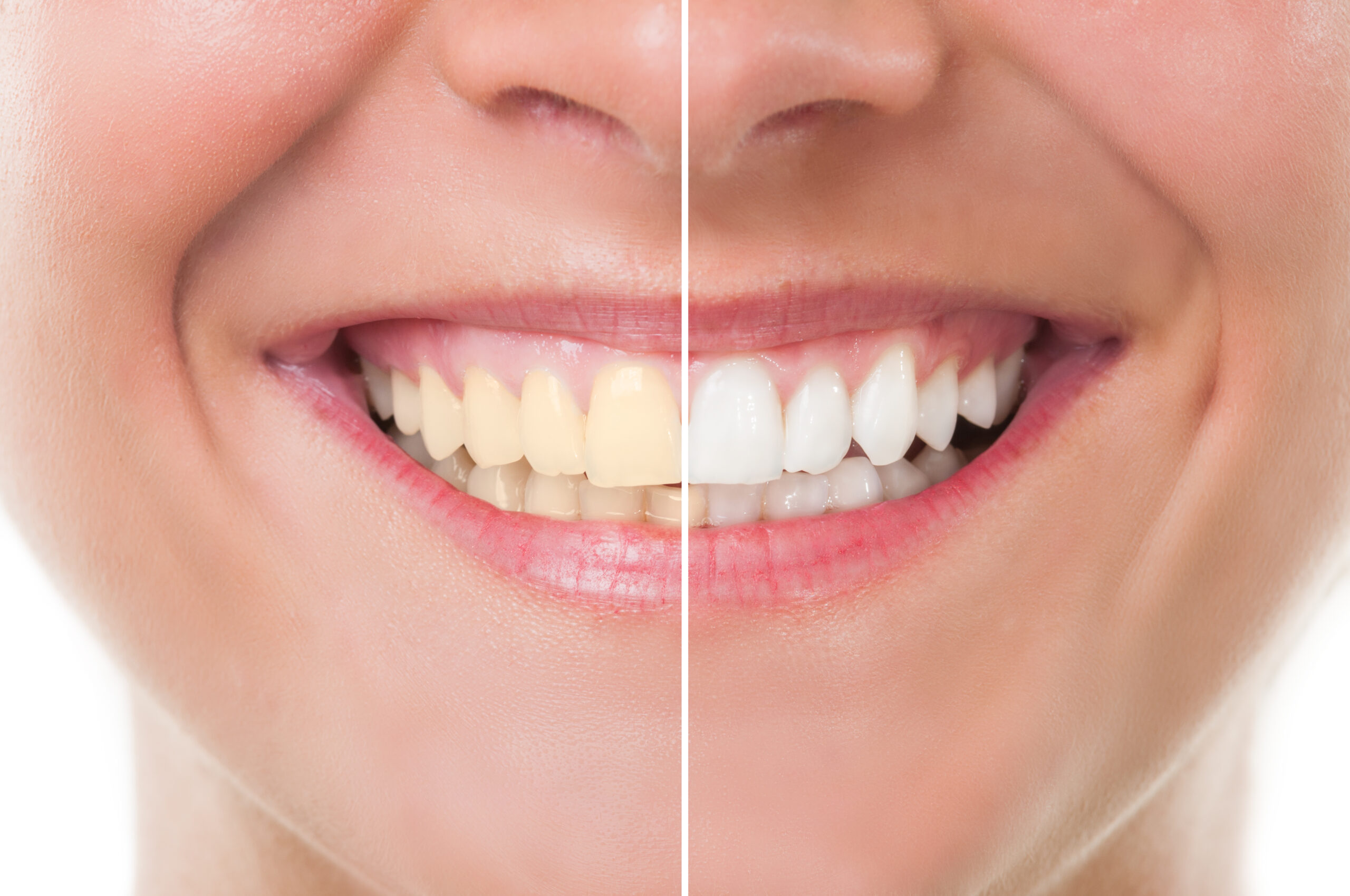 the-advantages-and-procedures-of-teeth-whitening