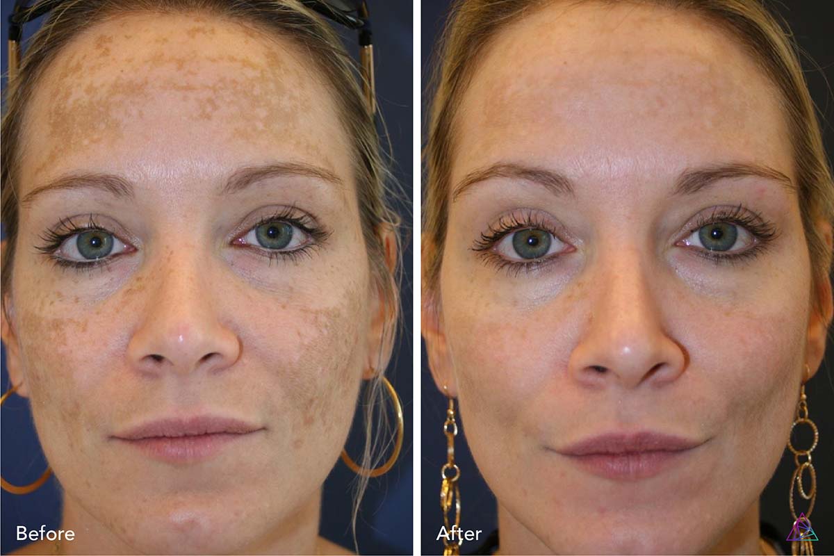 Laser Resurfacing