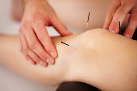 acupuncture for knee pain