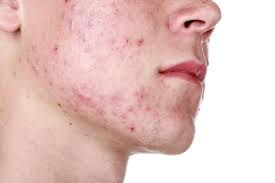 influence acne conglobata