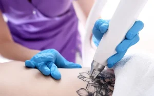 laser tattoo removal fort lauderdale