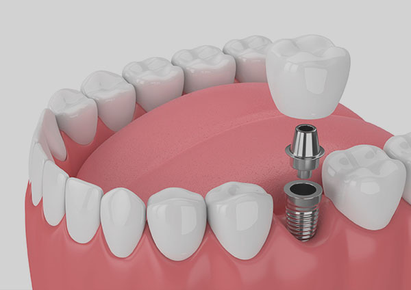 Single Tooth Implant Cost in Dubai