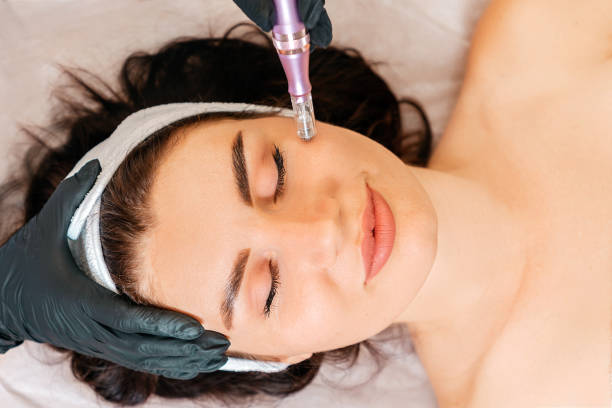 Fractional RF Micro Needling in Abu Dhabi