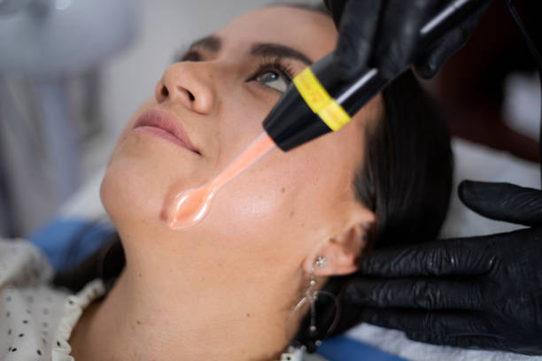 Fractional RF micro needling in Abu Dhabi