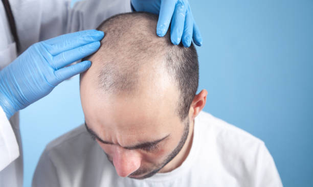 Male Hair Transplant In Abu Dhabi