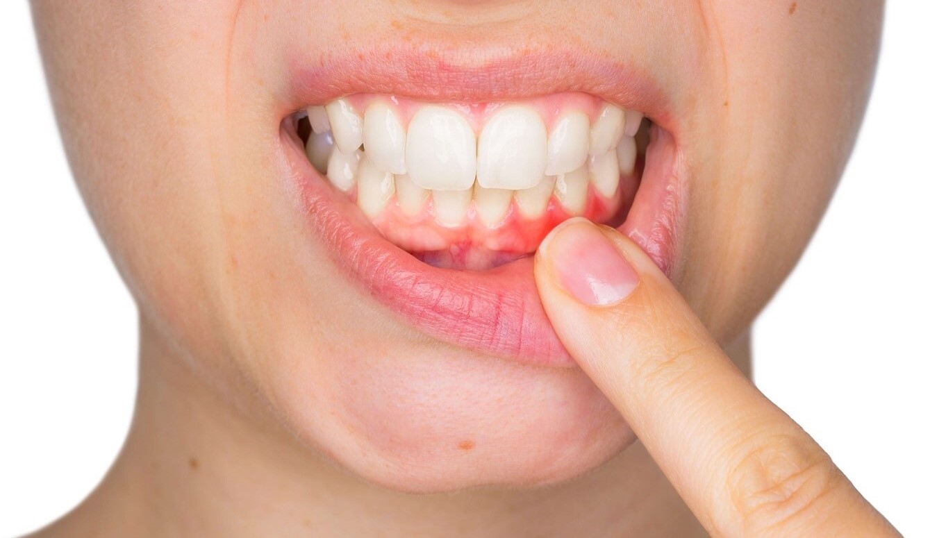 Gum Disease Treatment Strategies: Enhancing Oral Health