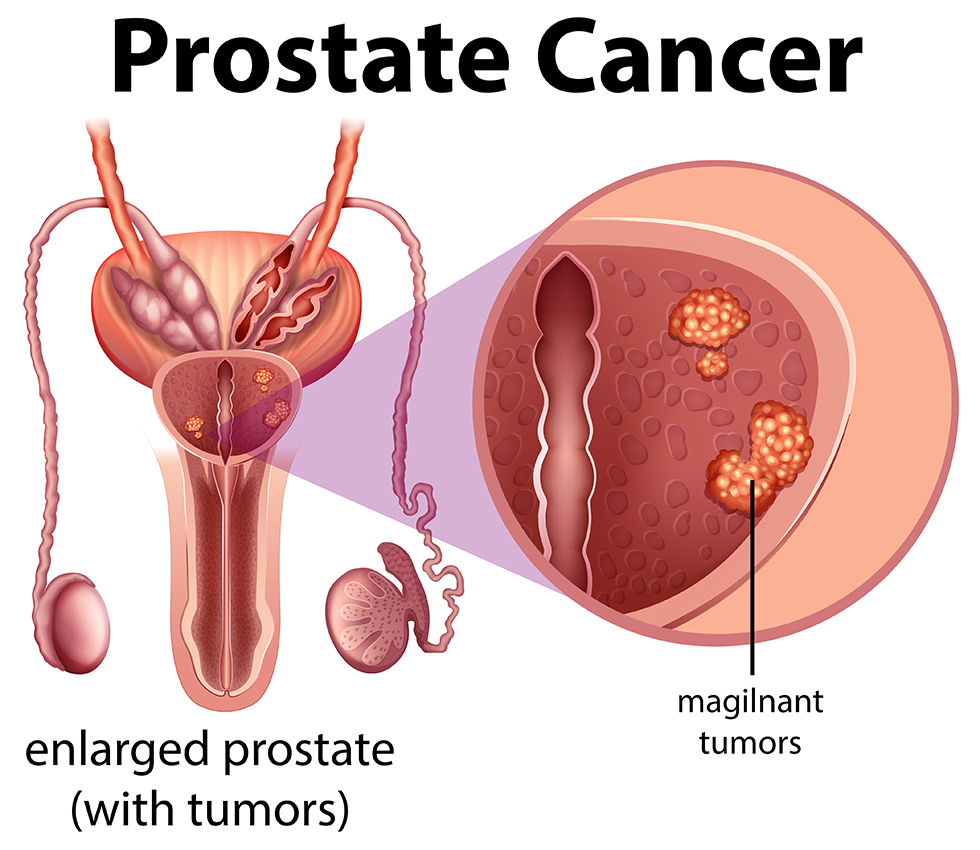 medical-oncologist-in-India-prostate-cancer