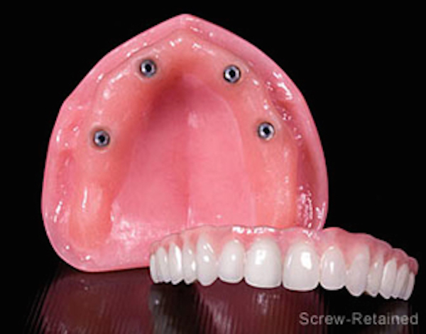 Implant Dentures