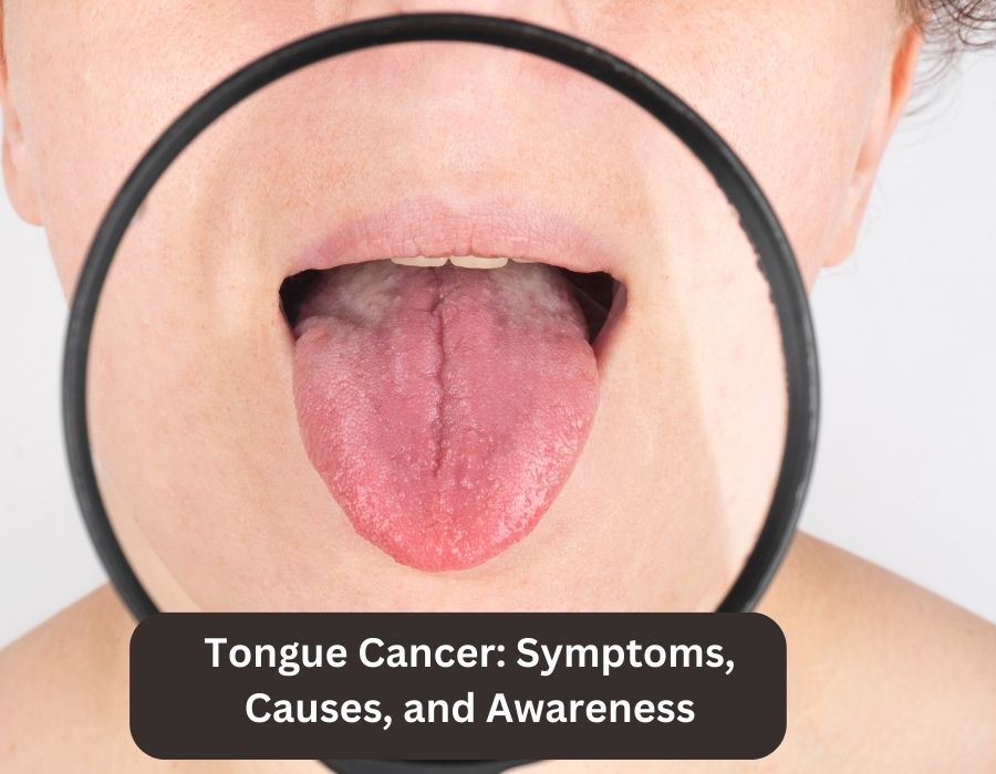 cancer-doctor-in-bangalore-tongue-cancer