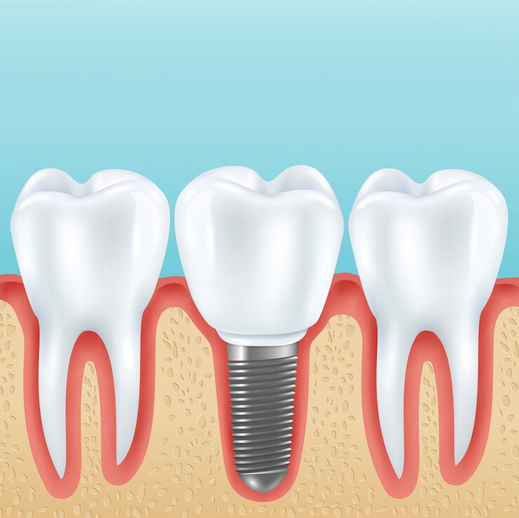 dental implants