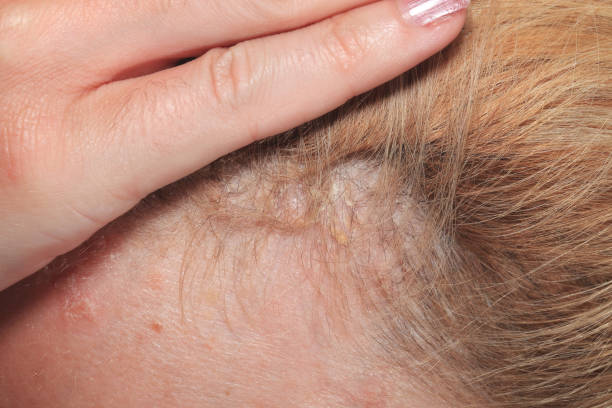 Actinic keratosis treatment in Abu Dhabi