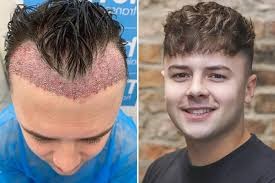 Hair Transplant