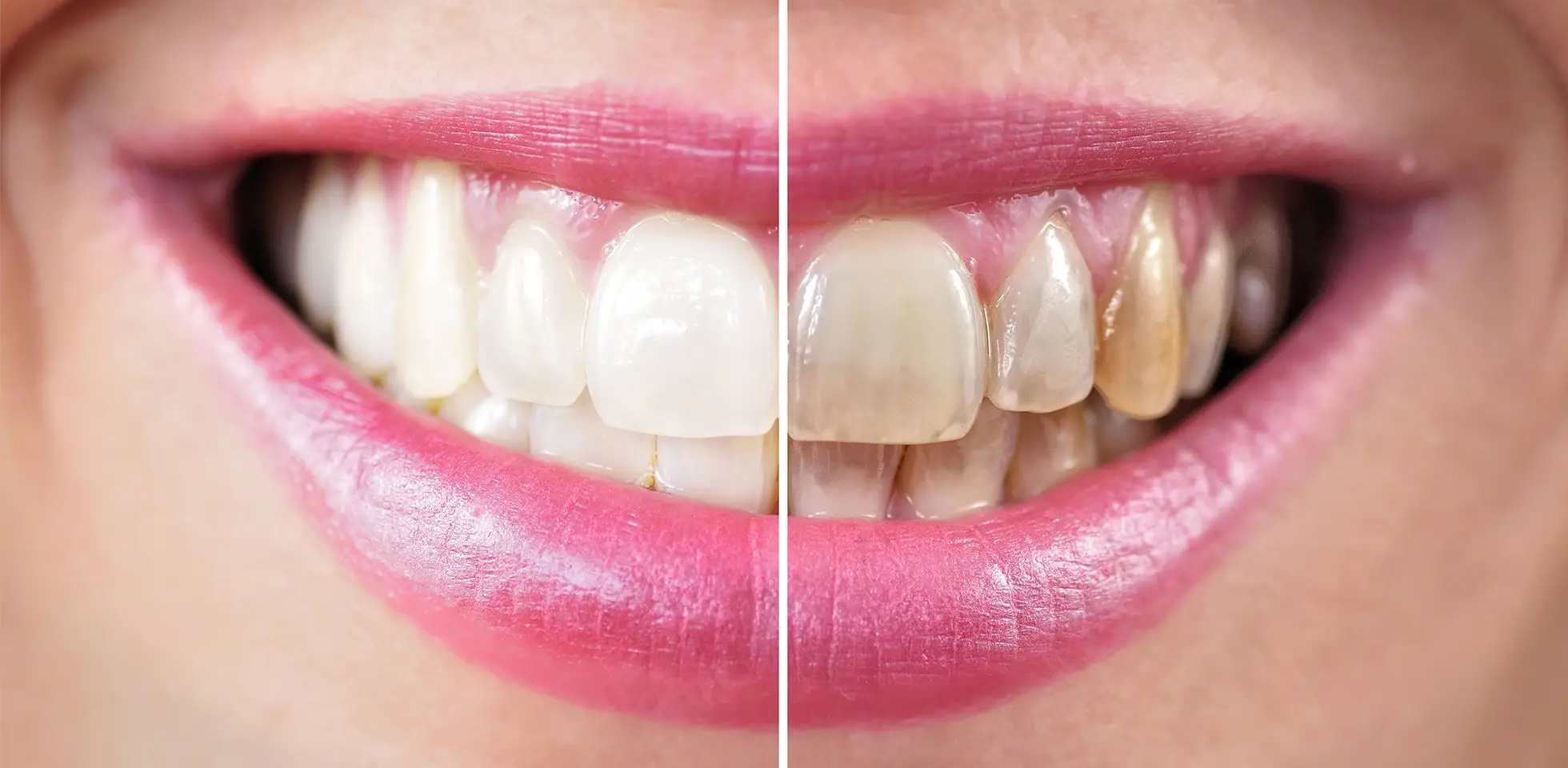 The Myths and Facts Behind Teeth Whitening