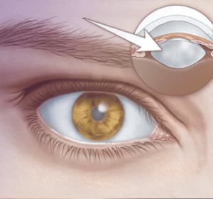 Best Cataract Surgeon In Delhi A Modern Approach